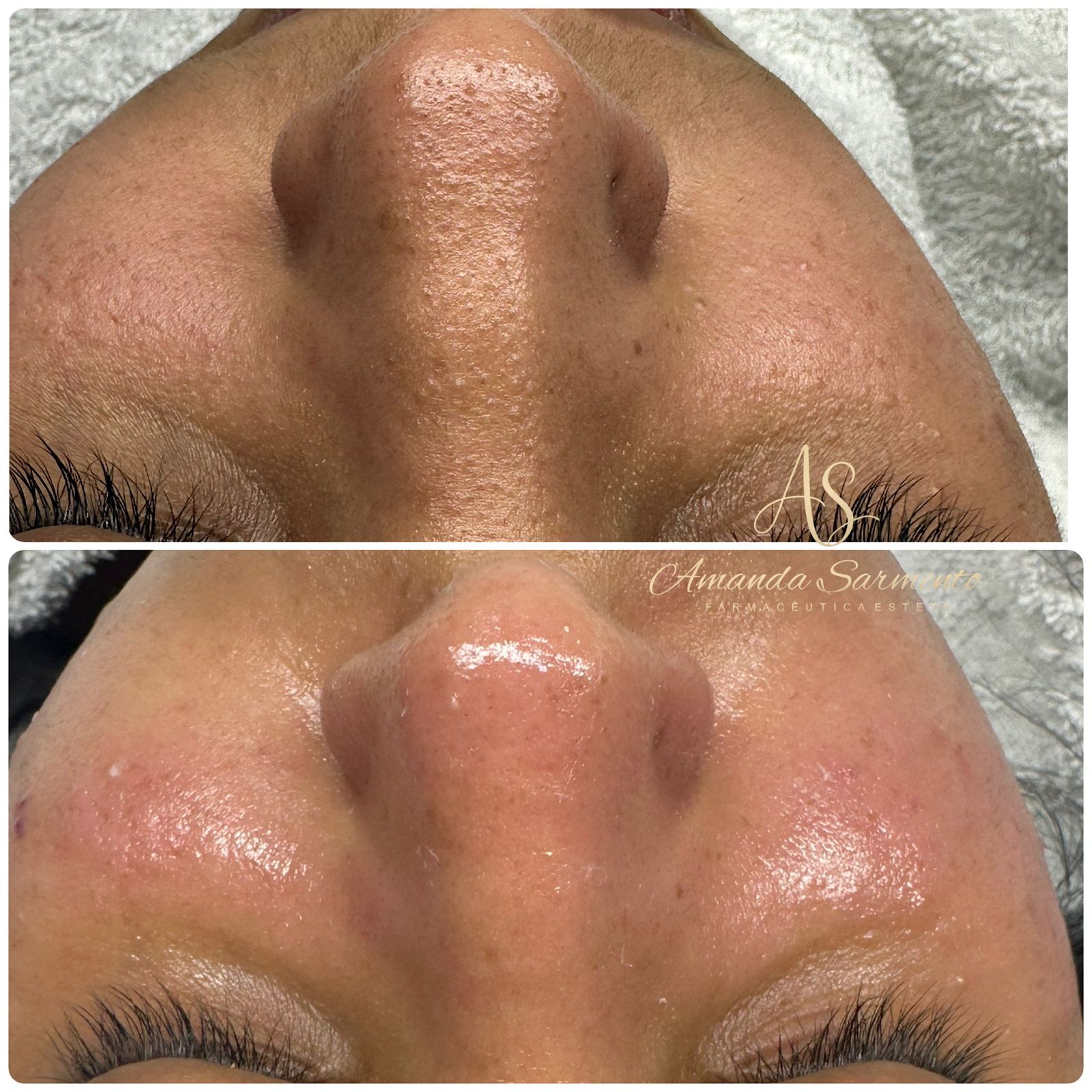 Resultado 2: antes e depois de limpeza de pele com peeling coreano