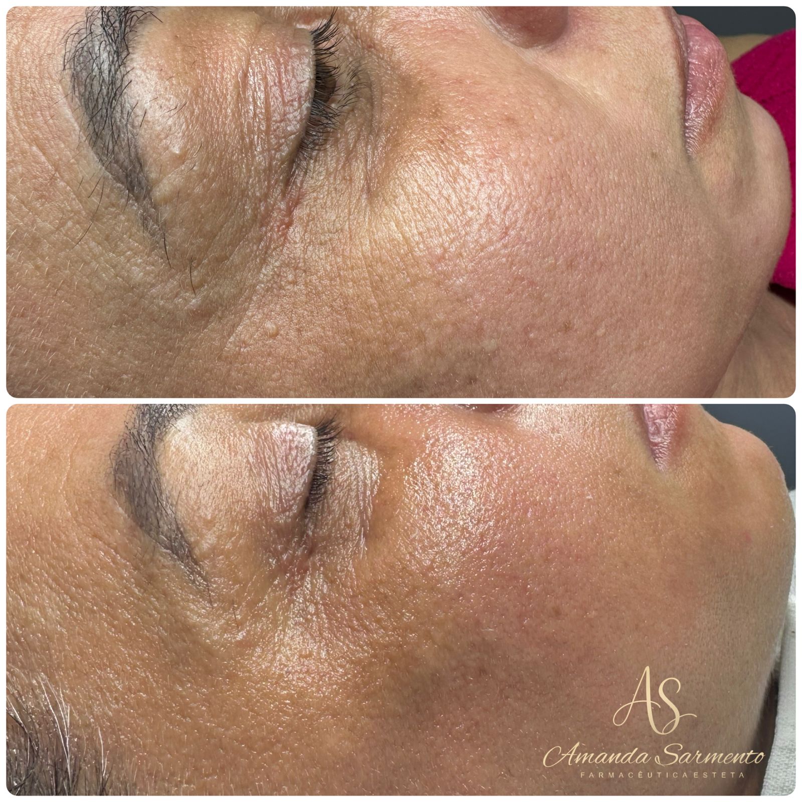 Resultado 3: antes e depois de limpeza de pele com peeling coreano