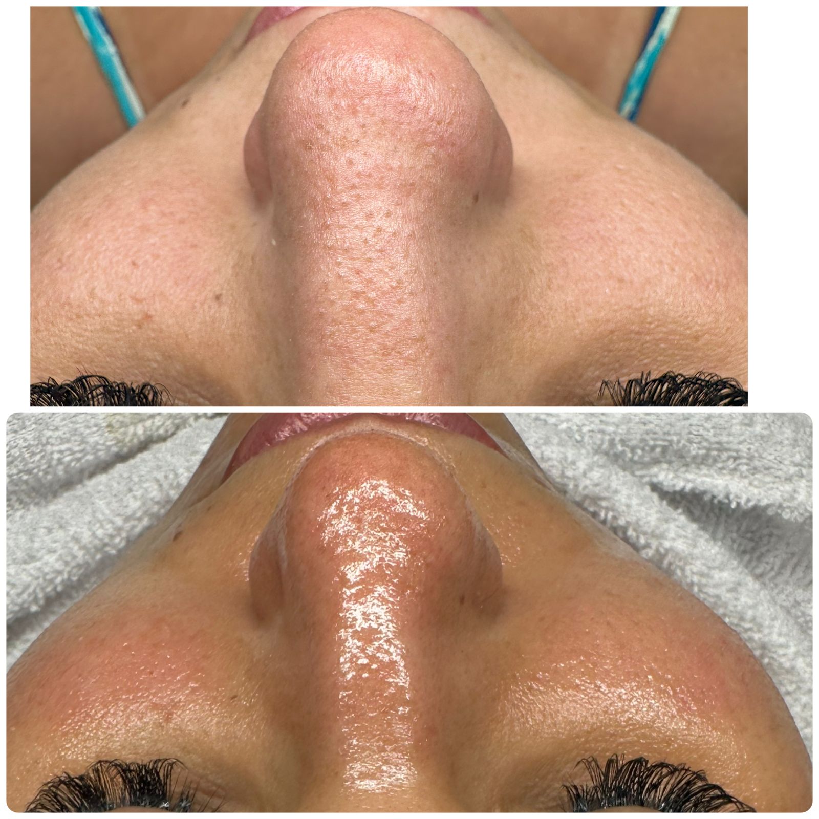 Resultado 1: antes e depois de limpeza de pele com peeling coreano